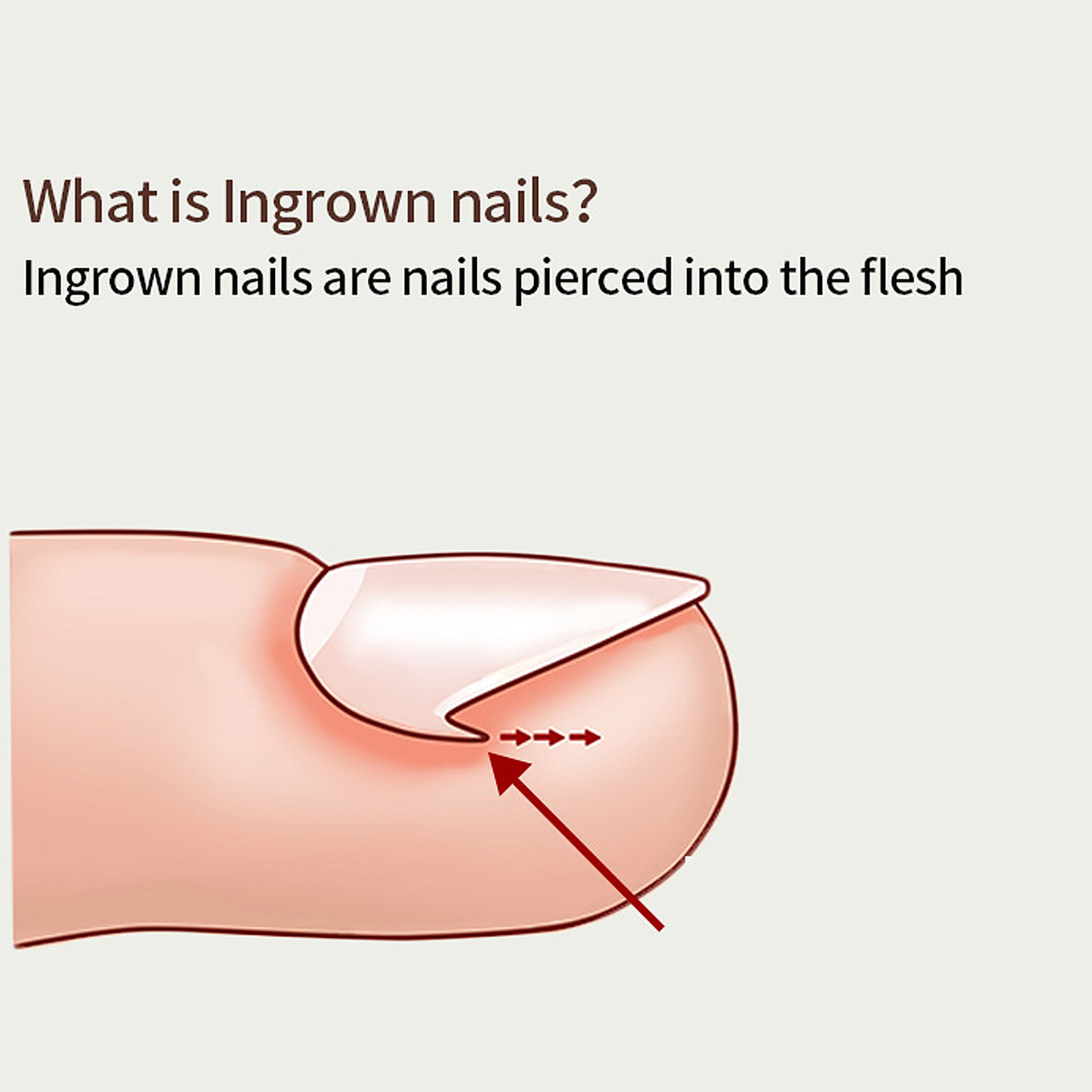 Ingrown Toe Nail Correction Pad Nail Clipper Ingrown Toenail Lifter Tweezers TJS
