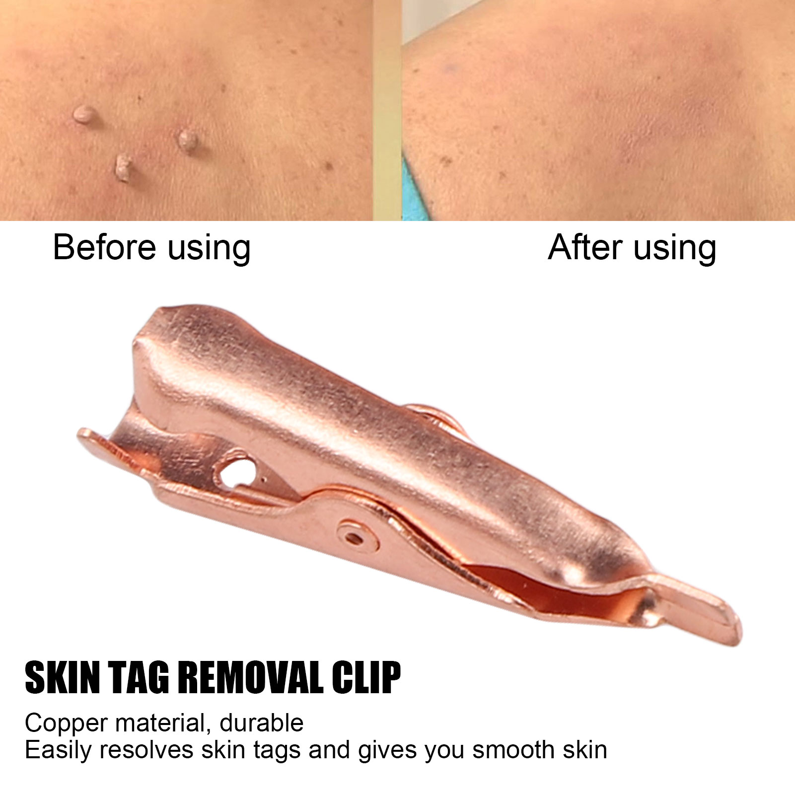 Skin Tag Remover Clips Safe Copper Smooth Skin Tag Removal Tool For Face L2S - Picture 24 of 29